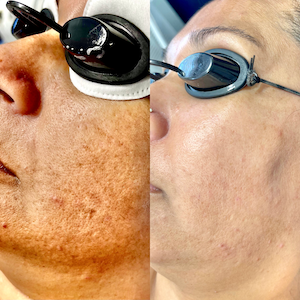 Carbon Laser Facial Before and After thumbnail