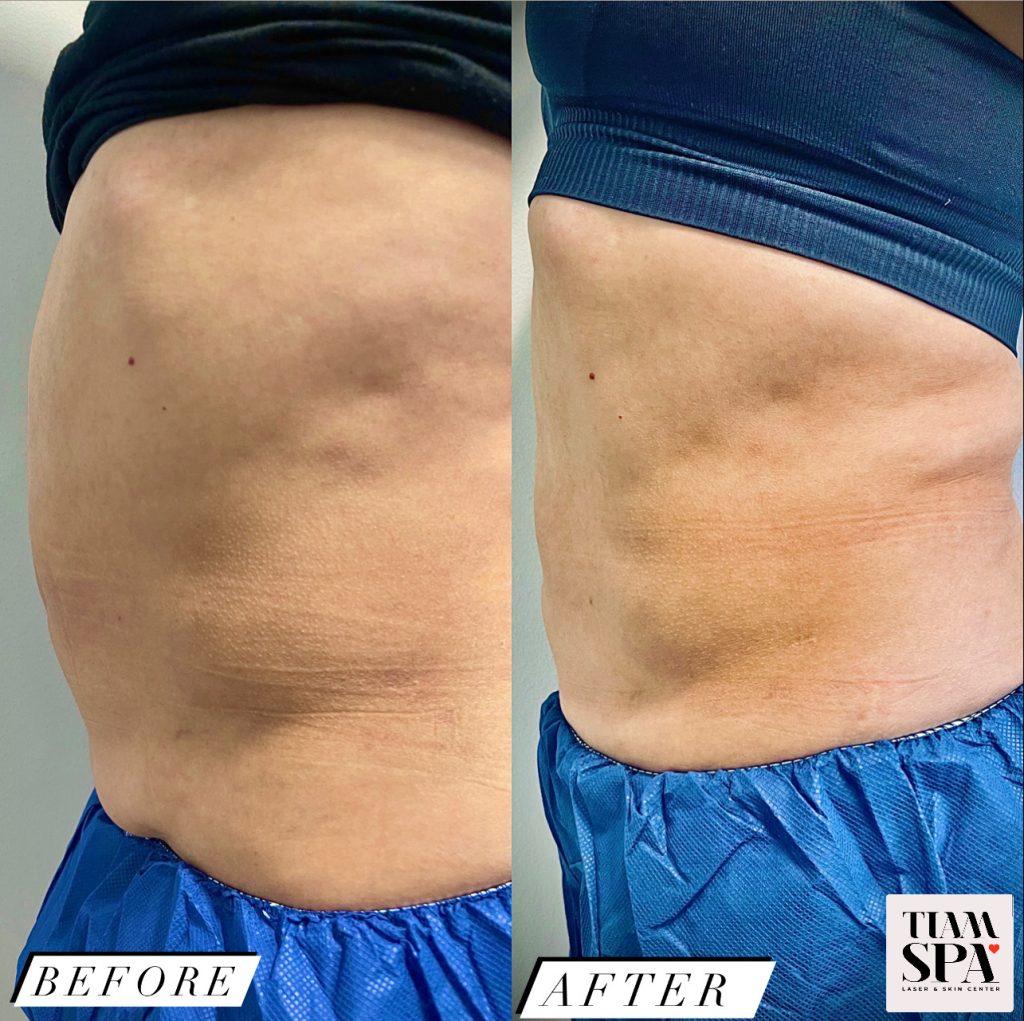 EMS Sculpting Before and After image
