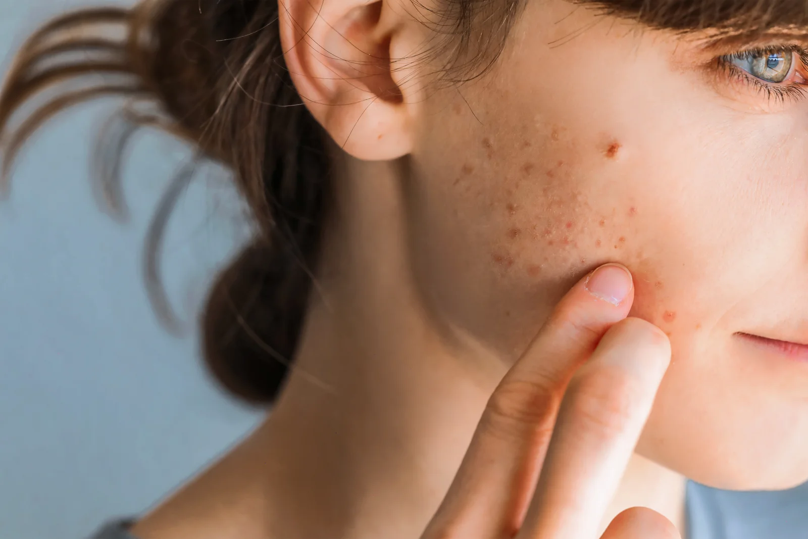 Benefits of Microdermabrasion for Acne and Scar Reduction