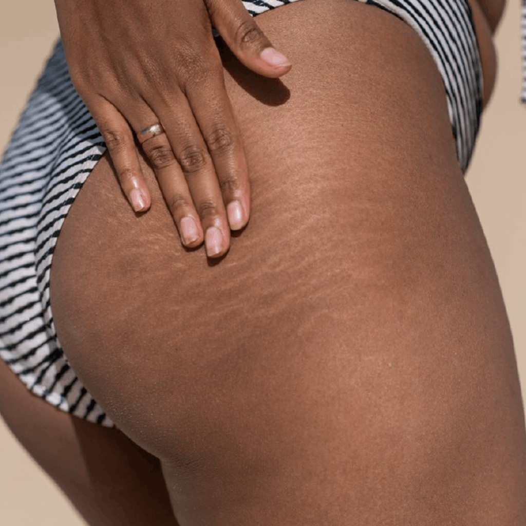 Scars & Stretch Mark Remodeling