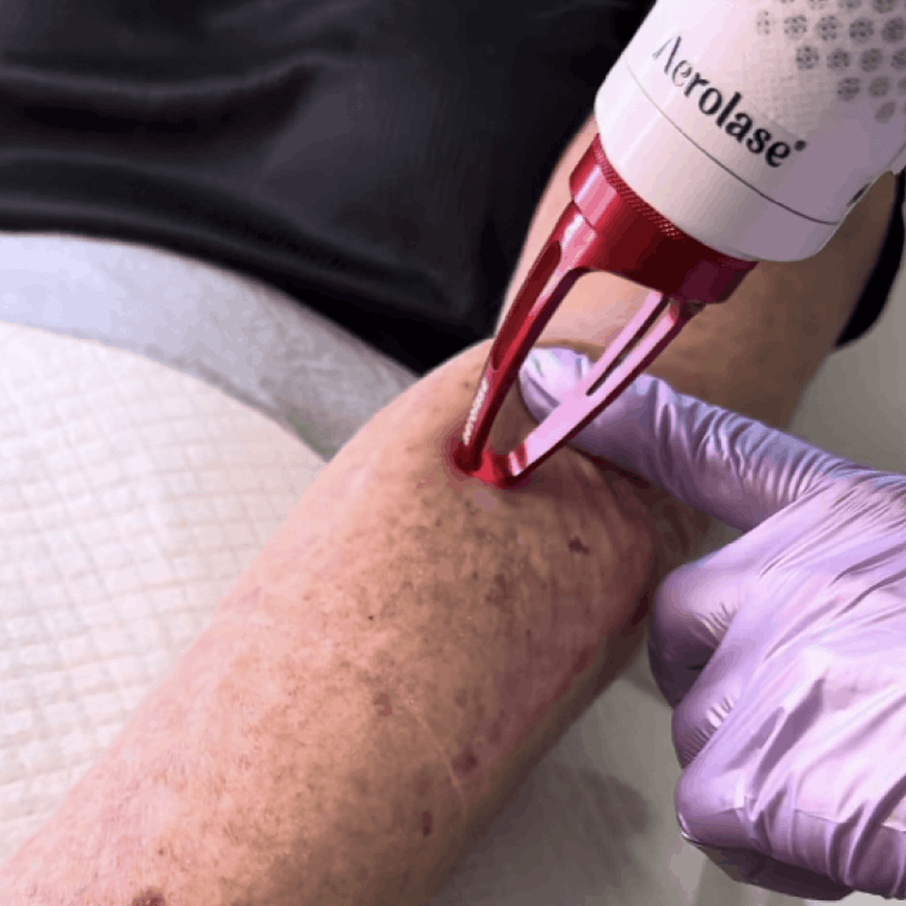 Hyperpigmentation & Sun Damage Correction