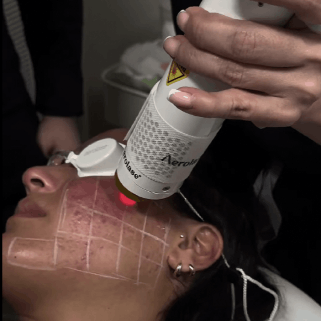 active and hormonal Acne Therapy